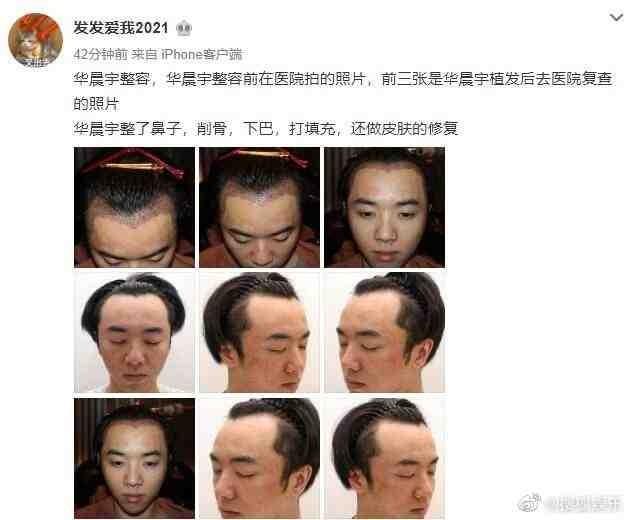 华晨宇整容前后照片（疑正宫曝光华晨宇整容出轨同私密床照）